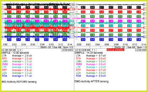 electromyography