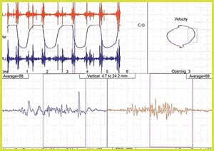 sonographie